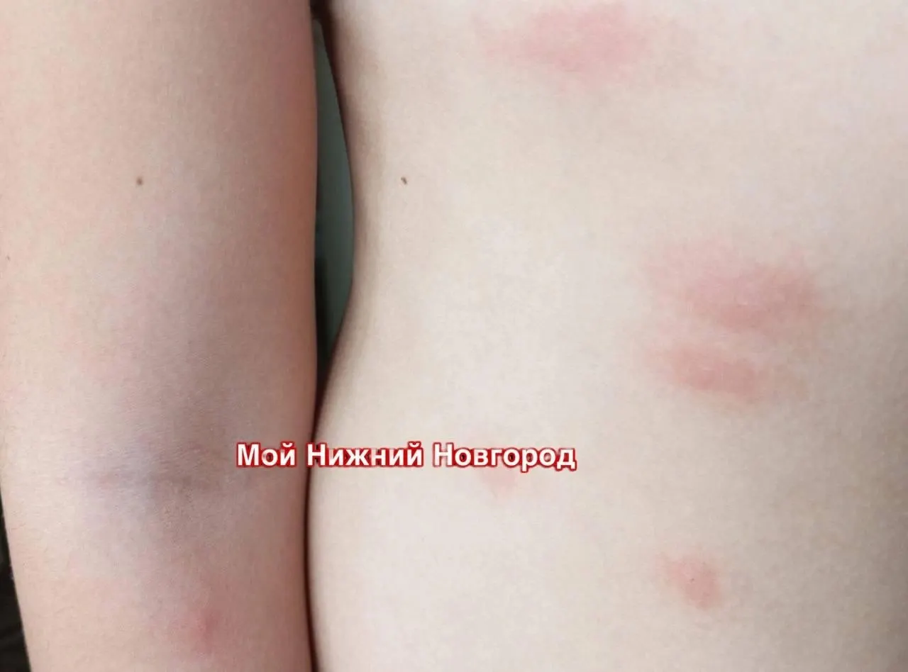 Жители отмечают сильный зуд и сыпь — возможный случай церкариоза. Роспотребнадзор передал данные в комитет ветеринарии, пробы воды проверят, купание могут запретить.